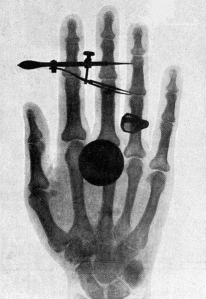 Roentgen's X-ray image of his wife, Anna's, hand. On seeing this she exclaimed 'I have seen my death'